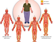 Fysiotherapie bij artrose: (h)erken de patiënt met sarcopene obesitas (VI)