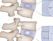 Het 'zware' leven van de lumbale disci intervertebrales (VI)