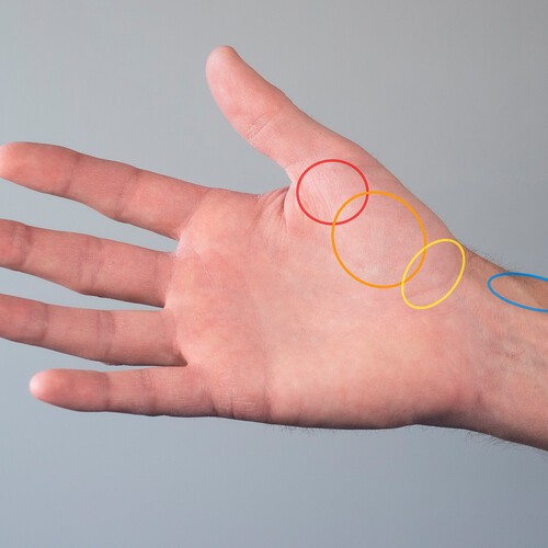 Diagnostiek en therapie bij pijn in de duimregio (AF, BD) Physios